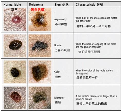 好的痣|痣也可能会癌变！长在 3 个地方要注意